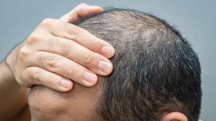 Wonder Drug for Male Baldness Sends Swiss Firm Cosmo’s Shares Soaring