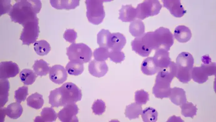 Cyclospora Outbreak in US: 700 Cases Reported Across 18 States, What You Need to Know