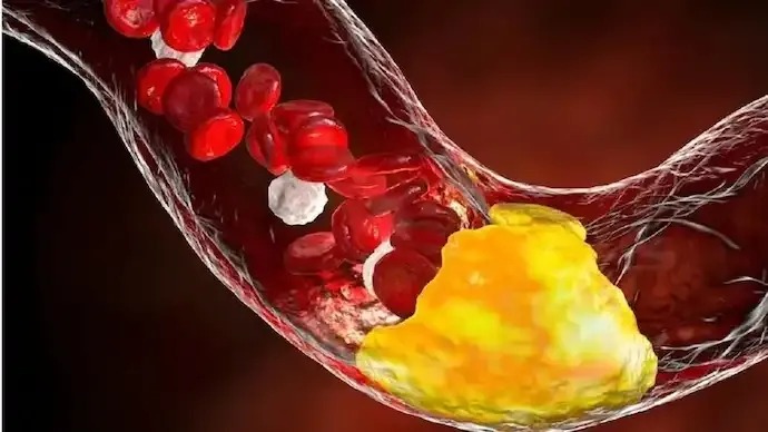 ICMR Study: Low Good Cholesterol Driving India's Growing Heart Disease Risk
